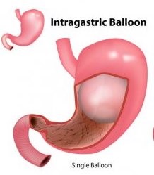 gastric balloon abroad